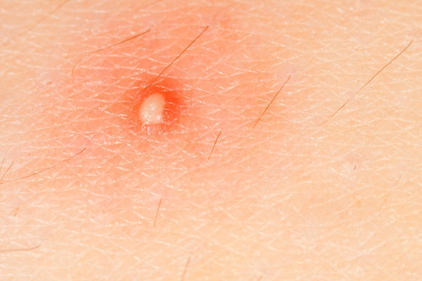 Home Remedies for Boils and Abscesses