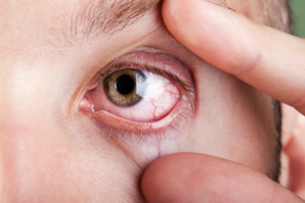 Eye Itching